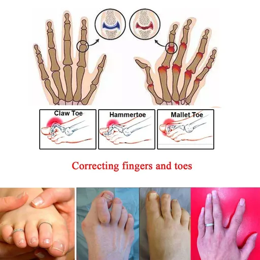 14 Pieces Broken Toe Wraps, Cushioned Bandages, Hammer Toe Separator Splints, Toe Straight, Hammer Toe Wrap, for Broken Toe