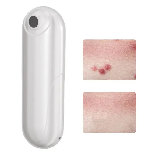Bug Bite Itch Relief Tool USB Rechargeable Mosquito Bite Sucker Chemical Free for Bug Bites Bee Wasp Stings